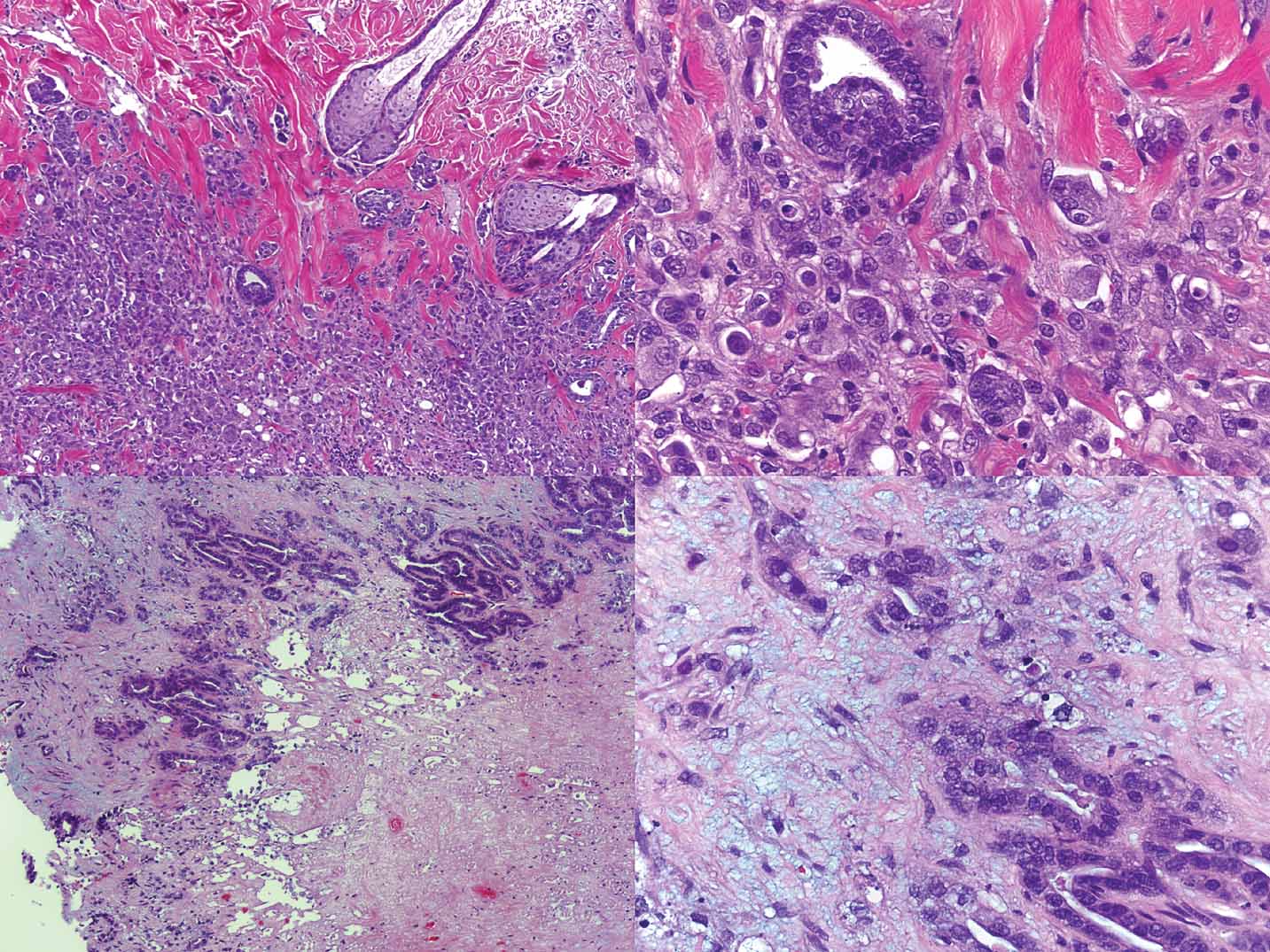 Gene Therapy for Cancer Treatment