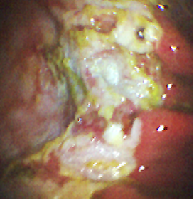 ulcer 2