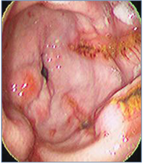 ulcer 3