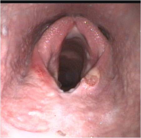 dorsally displaced epiglottis