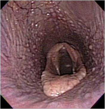 Dorsal Displacement of the Soft Palate in Horses